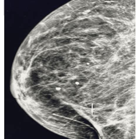 mammography compression test device|spot compression mammogram vs ultrasound.